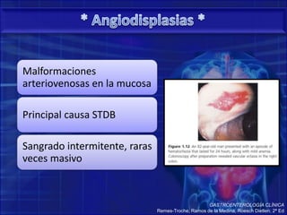 * Angiodisplasias *HematoqueciaGASTROENTEROLOGÍA CLÍNICARemes-Troche, Ramos de la Medina, RoeschDietlen; 2ª Ed