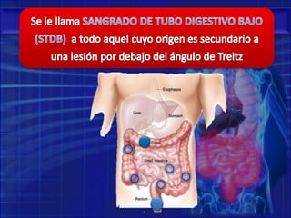 Se le llamaSANGRADO DE TUBO DIGESTIVO BAJO (STDB)a todo aquel cuyo origen es secundario a una lesión por debajo del ángulo de Treitz
