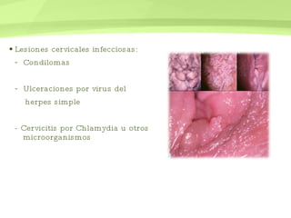 Lesiones cervicales infecciosas: Condilomas Ulceraciones por virus del  herpes simple - Cervicitis por Chlamydia u otros  microorganismos 