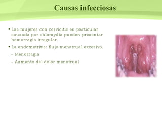 Causas infecciosas Las mujeres con cervicitis en particular causada por chlamydia pueden presentar hemorragia irregular. La endometritis: flujo menstrual excesivo. - Menorragia  - Aumento del dolor menstrual 