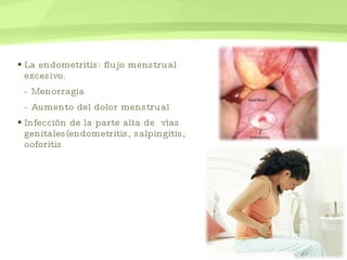 La endometritis: flujo menstrual excesivo. - Menorragia  - Aumento del dolor menstrual Infección de la parte alta de  vías genitales(endometritis, salpingitis, ooforitis 
