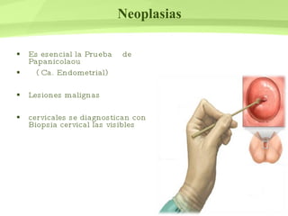 Neoplasias  Es esencial la Prueba  de Papanicolaou ( Ca. Endometrial) Lesiones malignas  cervicales se diagnostican con Biopsia cervical las visibles  