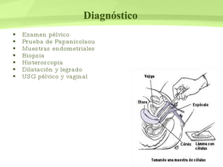 Diagnóstico Examen pélvico Prueba de Papanicolaou Muestras endometriales Biopsia Histeroscopia Dilatación y legrado USG pélvico y vaginal  