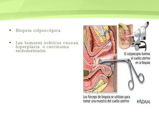 Biopsia colposcópica. Los tumores ováricos causan hiperplasia  o carcinoma endometriales 