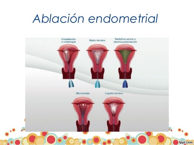 Hemorragia uterina anormal Hemorragia uterina anormal