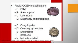 Malcom G Munro et al (2011) FIGO Classification system (PALM-COEIN) for causes of abnormal uterine
bleeding in nongravid women of reproductive age, international journal of Gynecology and obstatrics
 