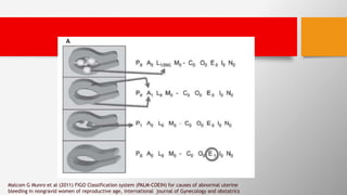 Malcom G Munro et al (2011) FIGO Classification system (PALM-COEIN) for causes of abnormal uterine
bleeding in nongravid women of reproductive age, international journal of Gynecology and obstatrics
 