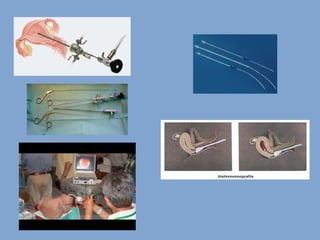 Hemorragia uterina anormal   2016