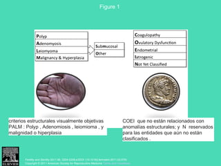 Figure 1 
Fertility and Sterility 2011 95, 2204-2208.e3DOI: (10.1016/j.fertnstert.2011.03.079) 
Copyright © 2011 American Society for Reproductive Medicine Terms and Conditions
criterios estructurales visualmente objetivas
PALM : Polyp , Adenomiosis , leiomioma , y
malignidad o hiperplasia
COEI que no están relacionados con
anomalías estructurales; y N reservados
para las entidades que aún no están
clasificados . 
 