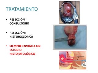 TRATAMIENTO
• RESECCIÓN :
CONSULTORIO
• RESECCIÓN:
HISTEROSCOPICA
• SIEMPRE ENVIAR A UN
ESTUDIO
HISTOPATOLÓGICO
 