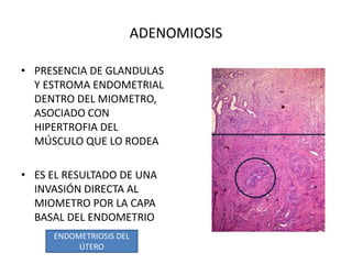 ADENOMIOSIS
• PRESENCIA DE GLANDULAS
Y ESTROMA ENDOMETRIAL
DENTRO DEL MIOMETRO,
ASOCIADO CON
HIPERTROFIA DEL
MÚSCULO QUE LO RODEA
• ES EL RESULTADO DE UNA
INVASIÓN DIRECTA AL
MIOMETRO POR LA CAPA
BASAL DEL ENDOMETRIO
ENDOMETRIOSIS DEL
ÚTERO
 