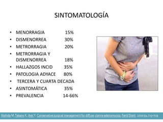 SINTOMATOLOGÍA
• MENORRAGIA 15%
• DISMENORREA 30%
• METRORRAGIA 20%
• METRORRAGIA Y
DISMENORREA 18%
• HALLAZGOS INCID 35%
• PATOLOGIA ADYACE 80%
• TERCERA Y CUARTA DECADA
• ASINTOMÁTICA 35%
• PREVALENCIA 14-66%
 