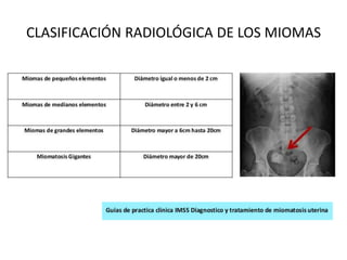 CLASIFICACIÓN RADIOLÓGICA DE LOS MIOMAS
 