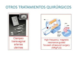 OTROS TRATAMIENTOS QUIRÚRGICOS
 