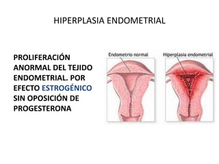HIPERPLASIA ENDOMETRIAL
PROLIFERACIÓN
ANORMAL DEL TEJIDO
ENDOMETRIAL. POR
EFECTO ESTROGÉNICO
SIN OPOSICIÓN DE
PROGESTERONA
 