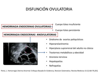 DISFUNCIÓN OVULATORIA
HEMORRAGIA ENDOCRINAS OVULATORIAS
• Cuerpo lúteo insuficiente
• Cuerpo lúteo persistente
HEMORRAGIA ENDOCRINAS ANOVULATORIAS
• Síndrome de ovarios poliquísticos
• Hiperprolactinemia
• Hiperplasia suprarrenal del adulto no clásica
• Trastornos metabólicos y obesidad
• Anorexia nerviosa
• Hepatopatías
• Nefropatías
Perez, L. Hemorragia Uterina Anormal: Enfoque Basado En Evidencia, Revision Sistematica. Revista Medicica 15 (1):68-79,2012
 