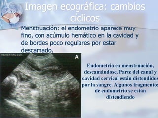 Imagen ecográfica: cambios
              cíclicos
   Menstruación: el endometrio aparece muy
    fino, con acúmulo hemático en la cavidad y
    de bordes poco regulares por estar
    descamado.

                           Endometrio en menstruación,
                          descamándose. Parte del canal y
                         cavidad cervical están distendidos
                         por la sangre. Algunos fragmentos
                               de endometrio se están
                                    distendiendo
 