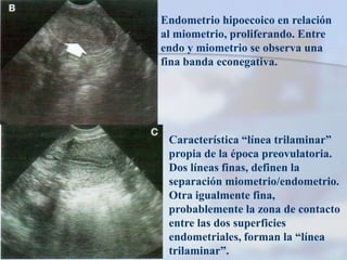 Endometrio hipoecoico en relación
al miometrio, proliferando. Entre
endo y miometrio se observa una
fina banda econegativa.




 Característica “línea trilaminar”
 propia de la época preovulatoria.
 Dos líneas finas, definen la
 separación miometrio/endometrio.
 Otra igualmente fina,
 probablemente la zona de contacto
 entre las dos superficies
 endometriales, forman la “línea
 trilaminar”.
 