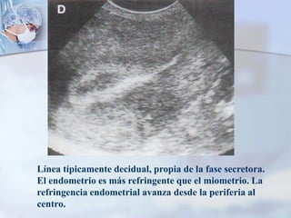 Línea típicamente decidual, propia de la fase secretora.
El endometrio es más refringente que el miometrio. La
refringencia endometrial avanza desde la periferia al
centro.
 