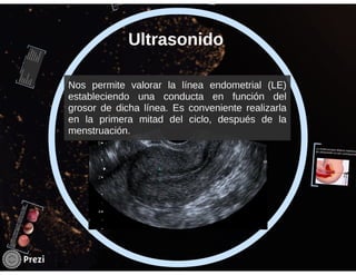 Hemorragia uterina disfuncional