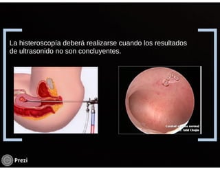 Hemorragia uterina disfuncional