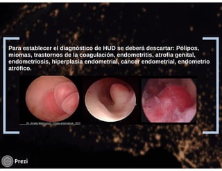 Hemorragia uterina disfuncional