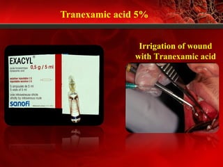 Tranexamic acid 5%
Irrigation of wound
with Tranexamic acid
 