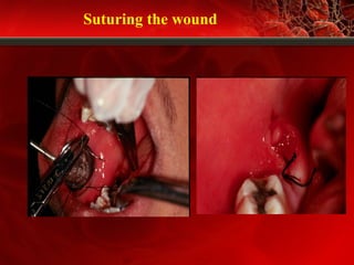 Suturing the wound
 