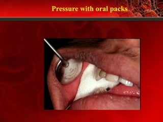 Pressure with oral packs
 