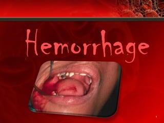 1
Hemorrhage
 