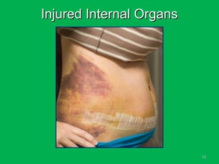 1313
Injured Internal OrgansInjured Internal Organs
 