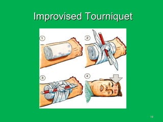 1818
Improvised TourniquetImprovised Tourniquet
 