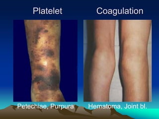 Platelet Coagulation
Petechiae, Purpura Hematoma, Joint bl.
 