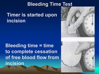Bleeding Time Test
Timer is started upon
incision
Bleeding time = time
to complete cessation
of free blood flow from
incision
 