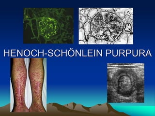 HENOCH-SCHÖNLEIN PURPURA
 
