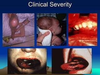 Clinical Severity
 
