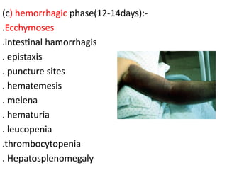 (c) hemorrhagic phase(12-14days):.Ecchymoses
.intestinal hamorrhagis
. epistaxis
. puncture sites
. hematemesis
. melena
. hematuria
. leucopenia
.thrombocytopenia
. Hepatosplenomegaly

 