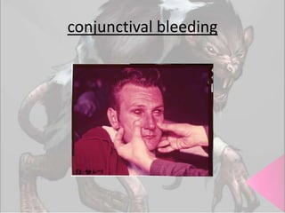 conjunctival bleeding

 