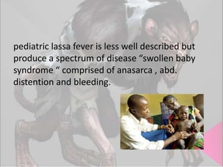 pediatric lassa fever is less well described but
produce a spectrum of disease “swollen baby
syndrome “ comprised of anasarca , abd.
distention and bleeding.

 