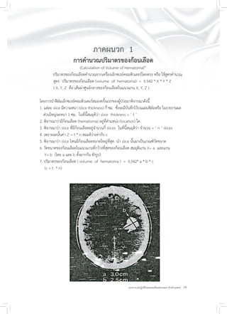 29แนวทางเวชปฏิบัติโรคหลอดเลือดสมองแตก สำหรับแพทย์
ภาคผนวก 1
การคำนวณปริมาตรของก้อนเลือด
(Calculation of Volume of Hematoma)21
ปริมาตรของก้อนเลือดคำนวณจากเครื่องเอ็กซเรย์คอมพิวเตอร์โดยตรง หรือ ใช้สูตรคำนวณ
สูตร ปริมาตรของก้อนเลือด (volume of hematoma) = 0.542 * X * Y * Z
( X, Y, Z คือ เส้นผ่าศูนย์กลางของก้อนเลือดในแนวแกน X, Y, Z )
โดยการนำฟิล์มเอ็กซเรย์คอมพิวเตอร์สมองครั้งแรกของผู้ป่วยมาพิจารณาดังนี้
1. แต่ละ slice มีความหนา (slice thickness) กี่ ซม. ซึ่งจะมีบันทึกไว้บนแผ่นฟิล์มหรือ ในรายงานผล
ส่วนใหญ่จะหนา 1 ซม. ในที่นี้สมมุติว่า slice thickness = ‘ t ’
2. พิจารณาว่ามีก้อนเลือด (hematoma) อยู่ที่ตำแหน่ง (location) ใด
3. พิจารณาว่า slice ที่มีก้อนเลือดอยู่จำนวนกี่ slices ในที่นี้สมมุติว่า จำนวน = ‘ n ’ slices
4. เพราะฉะนั้นค่า Z = t * n สมมติว่าเท่ากับ c
5. พิจารณาว่า slice ไหนมีก้อนเลือดขนาดใหญ่ที่สุด นำ slice นั้นมาเป็นเกณฑ์วัดขนาด
6. วัดขนาดของก้อนเลือดในแนวแกนที่กว้างที่สุดของก้อนเลือด สมมุติแกน X= a และแกน
Y= b (โดย a และ b ตั้งฉากกัน ดังรูป)
7. ปริมาตรของก้อนเลือด ( volume of hematoma ) = 0.542* a * b * c
(c = t * n)
 