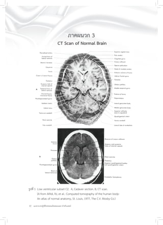 32 แนวทางเวชปฏิบัติโรคหลอดเลือดสมองแตก สำหรับแพทย์
ภาคผนวก 3
CT Scan of Normal Brain
รูปที่ 1 Low ventricular subset C2. A, Cadaver section. B, CT scan.
(A from Alﬁdi, RJ, et al.: Computed tomography of the human body:
An atlas of normal anatomy, St. Louis, 1977, The C.V. Mosby Co.)
 