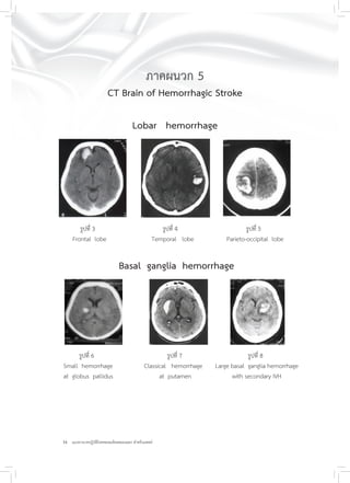 34 แนวทางเวชปฏิบัติโรคหลอดเลือดสมองแตก สำหรับแพทย์
ภาคผนวก 5
CT Brain of Hemorrhagic Stroke
Lobar hemorrhage
รูปที่ 3 รูปที่ 4 รูปที่ 5
Frontal lobe Temporal lobe Parieto-occipital lobe
Basal ganglia hemorrhage
รูปที่ 6 รูปที่ 7 รูปที่ 8
Small hemorrhage Classical hemorrhage Large basal ganglia hemorrhage
at globus pallidus at putamen with secondary IVH
 