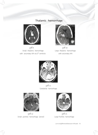 35แนวทางเวชปฏิบัติโรคหลอดเลือดสมองแตก สำหรับแพทย์
Thalamic hemorrhage
รูปที่ 9 รูปที่ 10
Small thalamic hemorrhage Large thalamic hemorrhage
with secondary IVH via 3rd
ventricle with secondary IVH
รูปที่ 11
Cerebellar hemorrhage
รูปที่ 12 รูปที่ 13
Small pontine hemorrhage (arrow) Large Pontine hemorrhage
 