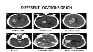 DIFFERENT LOCATIONS OF ICH
 