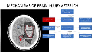 MECHANISMS OF BRAIN INJURY AFTER ICH
 