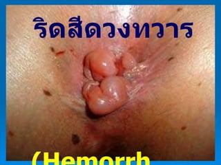 ริดสีดวงทวาร (Hemorrhoid) 