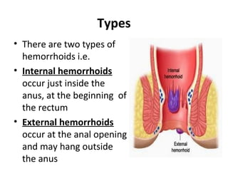 Hemorrhoid 161023041010 PDF