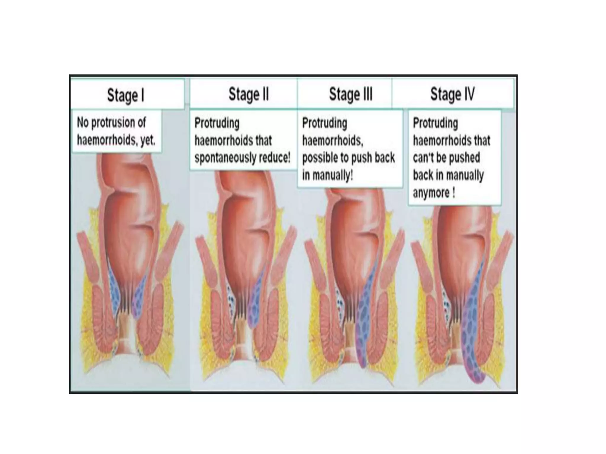 Hemorrhoid PPTX