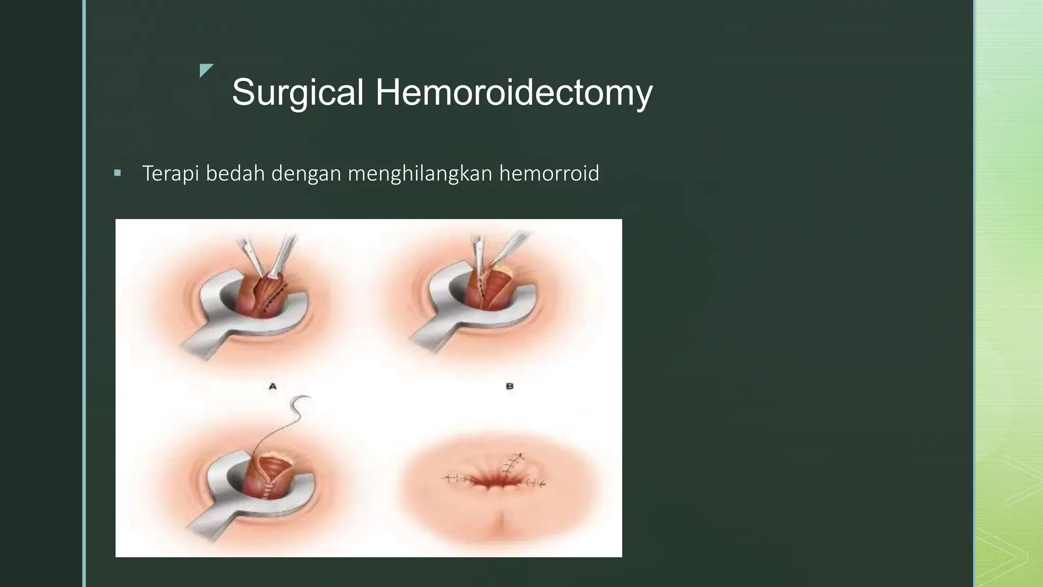 Hemorrhoid pptx