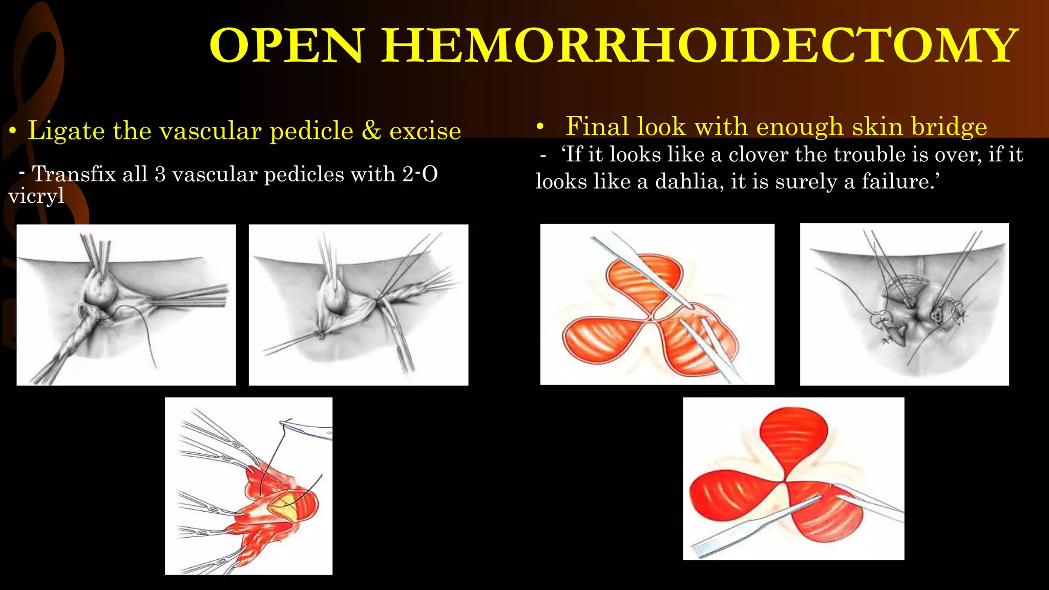 Hemorrhoidectomy Operative Surgery PPTX hemorrhoidectomy-operative-surgery-pptx